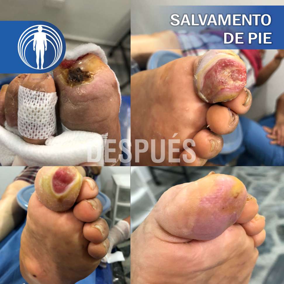 Pie diabético imagen demostrativa